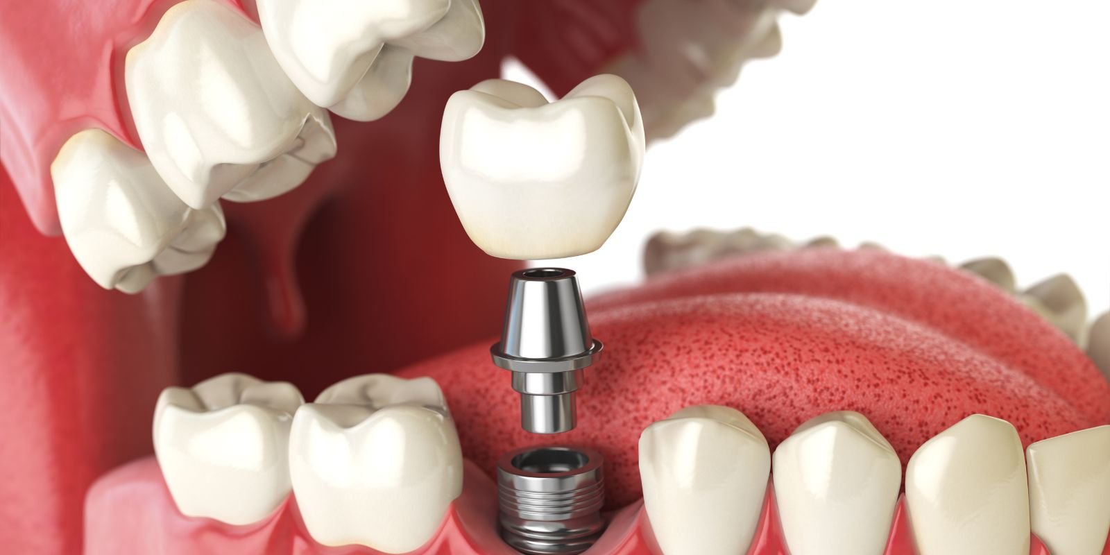 Dental Crowns